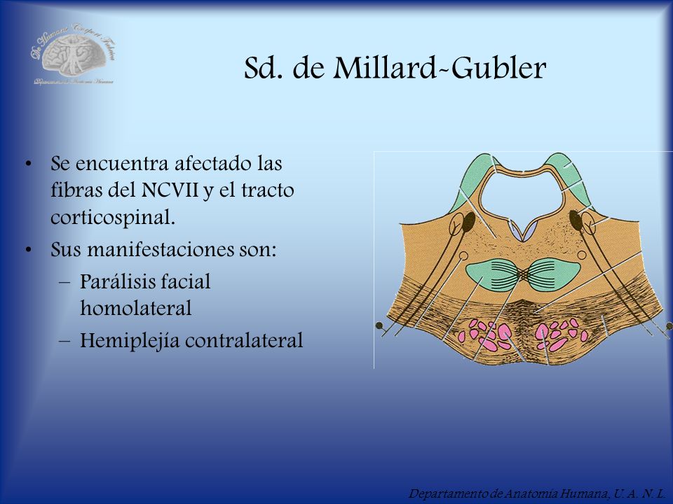Sd. de Millard-Gubler Se encuentra afectado las fibras del NCVII y el tracto corticospinal. Sus manifestaciones son: