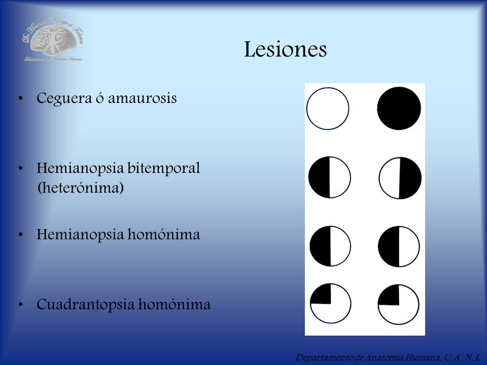 Lesiones Ceguera ó amaurosis Hemianopsia bitemporal (heterónima)