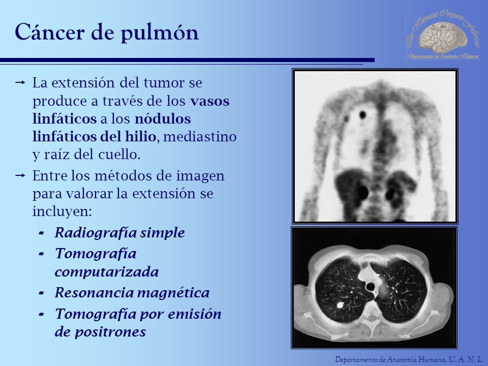 Cáncer de pulmón La extensión del tumor se produce a través de los vasos linfáticos a los nódulos linfáticos del hilio, mediastino y raíz del cuello.