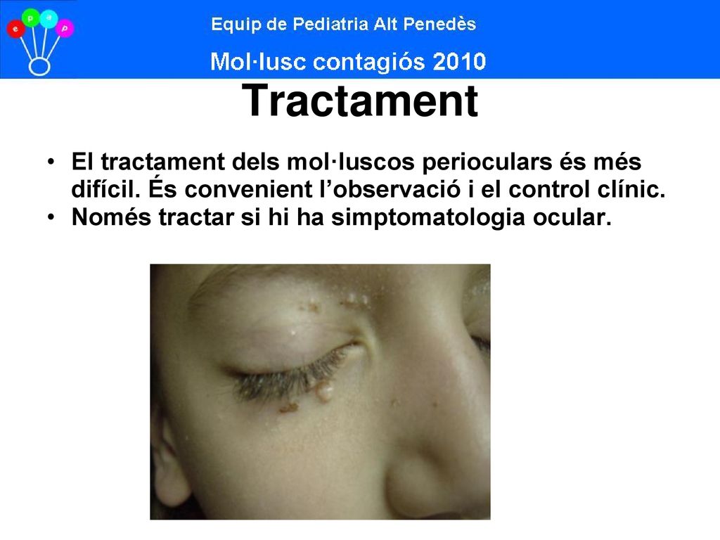 Tractament El tractament dels mol·luscos perioculars és més difícil. És convenient l’observació i el control clínic.