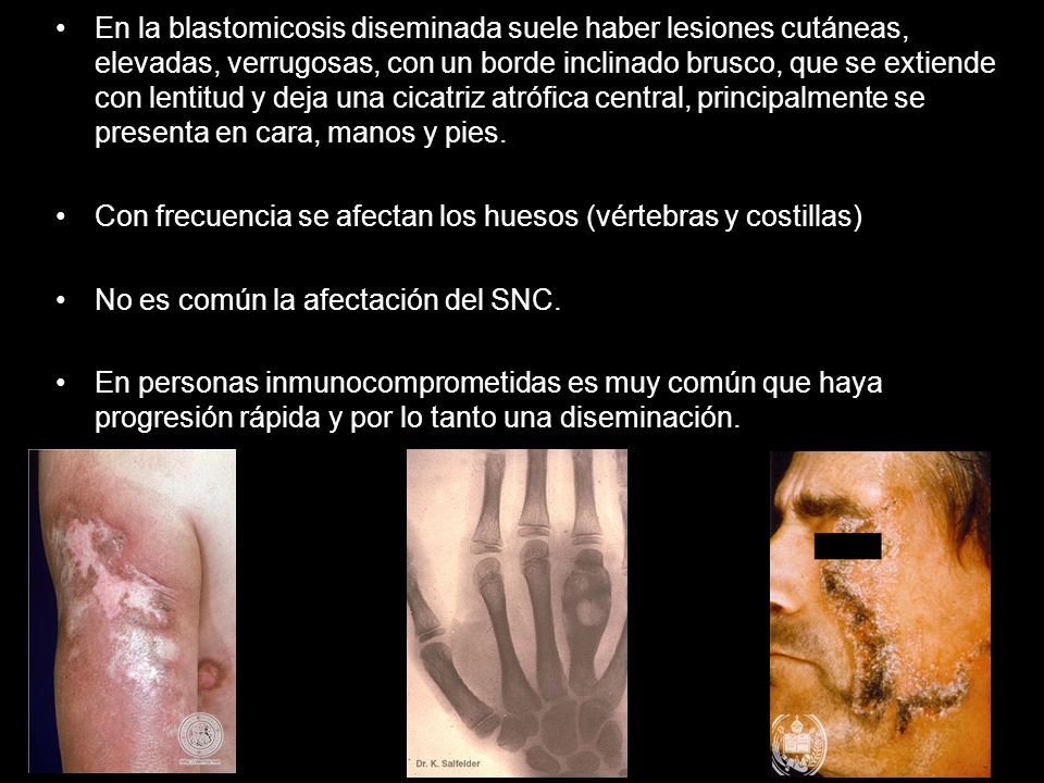 En la blastomicosis diseminada suele haber lesiones cutáneas, elevadas, verrugosas, con un borde inclinado brusco, que se extiende con lentitud y deja una cicatriz atrófica central, principalmente se presenta en cara, manos y pies.