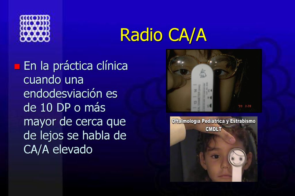 Radio CA/A En la práctica clínica cuando una endodesviación es de 10 DP o más mayor de cerca que de lejos se habla de CA/A elevado.