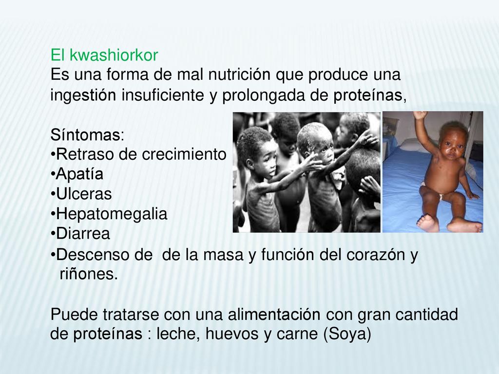 El kwashiorkor Es una forma de mal nutrición que produce una. ingestión insuficiente y prolongada.