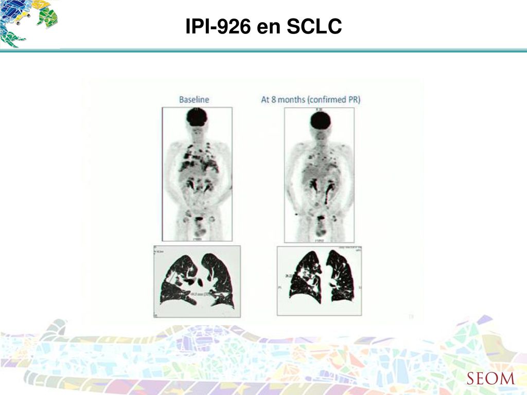 IPI-926 en SCLC