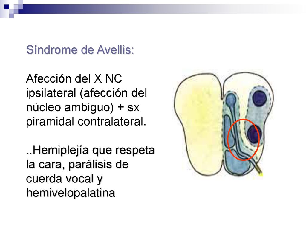 Síndrome de Avellis: Afección del X NC ipsilateral (afección del núcleo ambiguo) + sx piramidal contralateral.