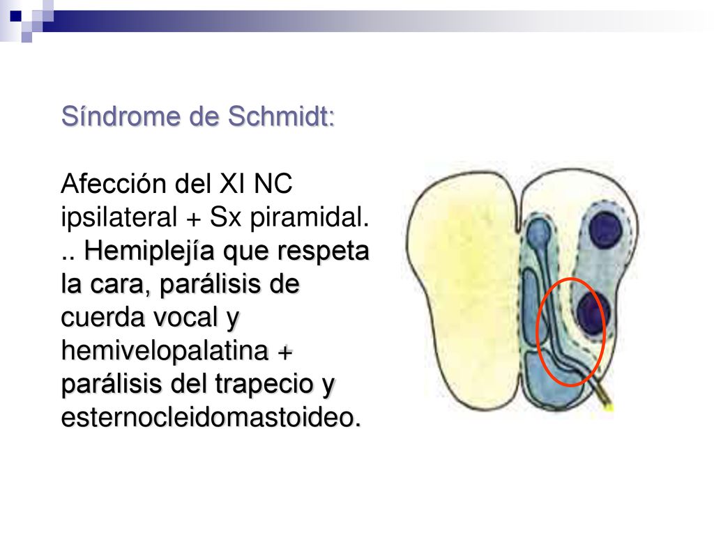 Síndrome de Schmidt: Afección del XI NC ipsilateral + Sx piramidal.