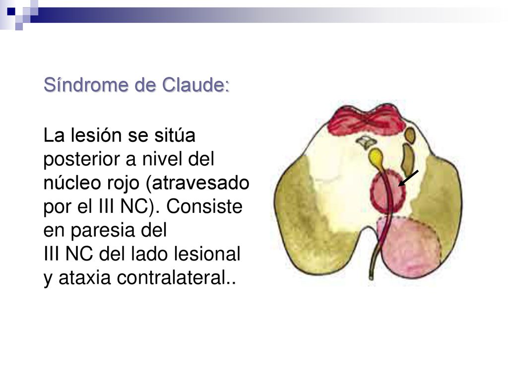 Síndrome de Claude: La lesión se sitúa posterior a nivel del. núcleo rojo (atravesado por el III NC). Consiste en paresia del.