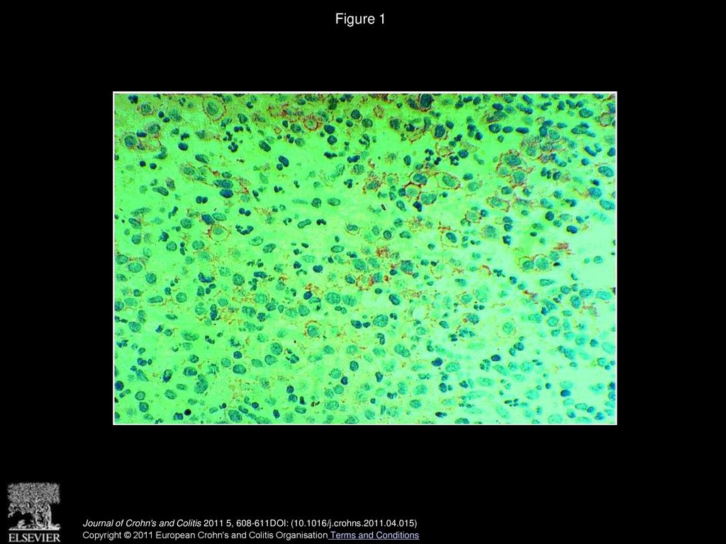 Figure 1 Histopathology of the biopsy: the large atypical blasts express the CD30-antigen.