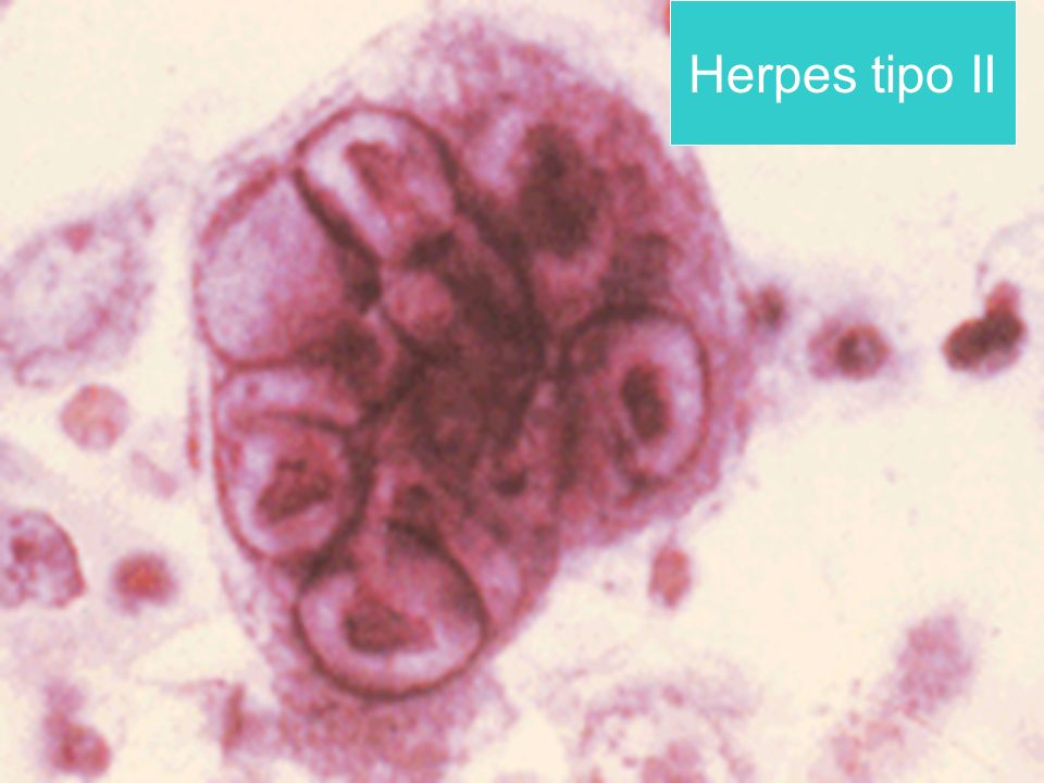 Herpes tipo II