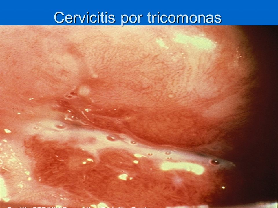 Cervicitis por tricomonas