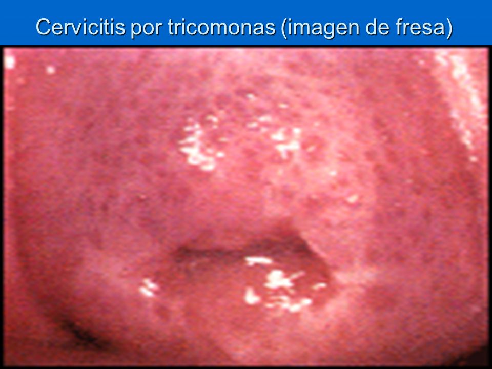 Cervicitis por tricomonas (imagen de fresa)