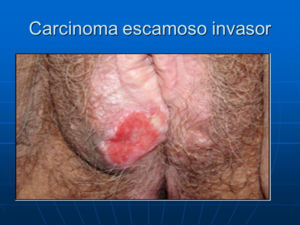 Carcinoma escamoso invasor