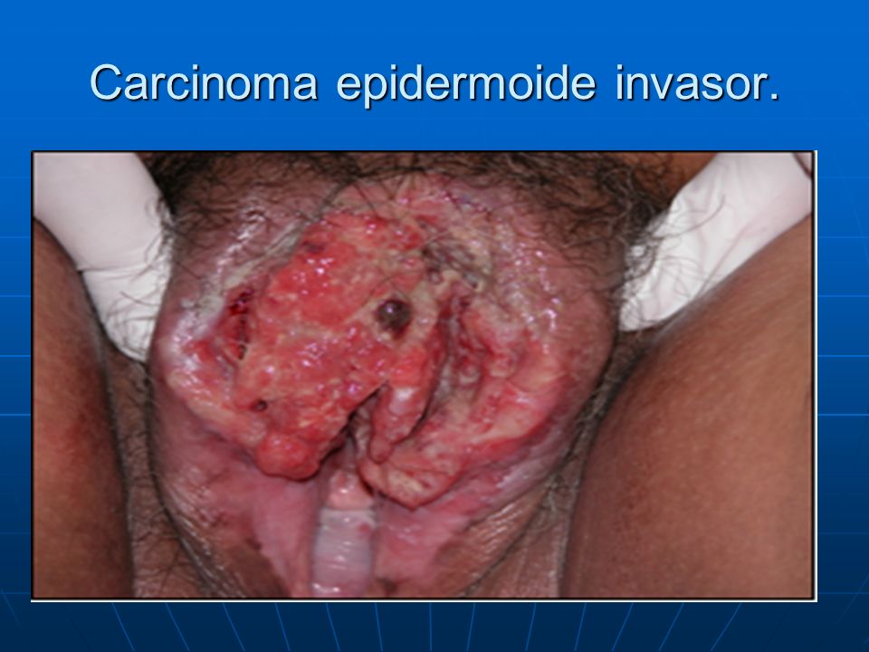 Carcinoma epidermoide invasor.