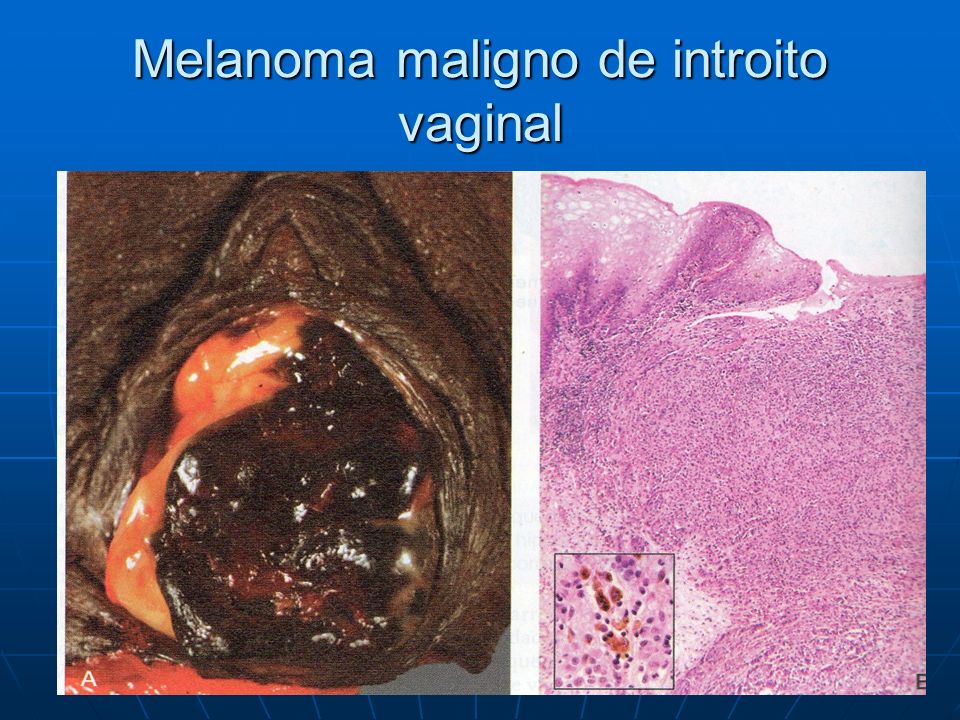 Melanoma maligno de introito vaginal