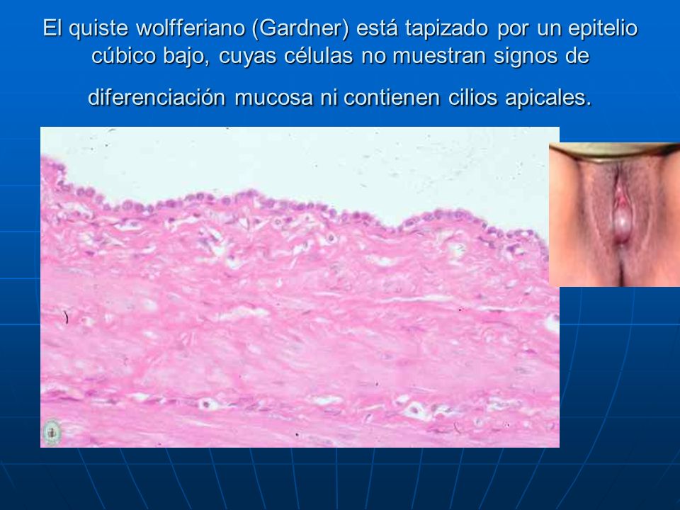 El quiste wolfferiano (Gardner) está tapizado por un epitelio cúbico bajo, cuyas células no muestran signos de diferenciación mucosa ni contienen cilios apicales.