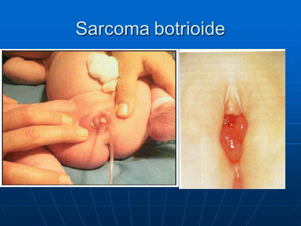 Sarcoma botrioide