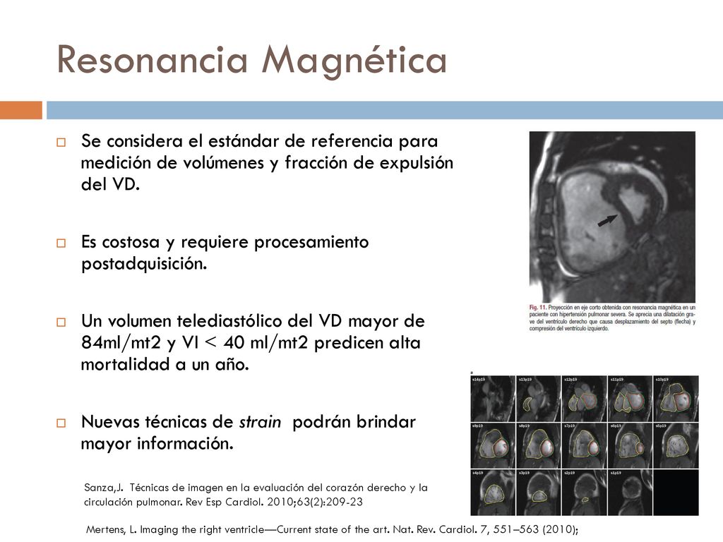 Resonancia Magnética Se considera el estándar de referencia para medición de volúmenes y fracción de expulsión del VD.