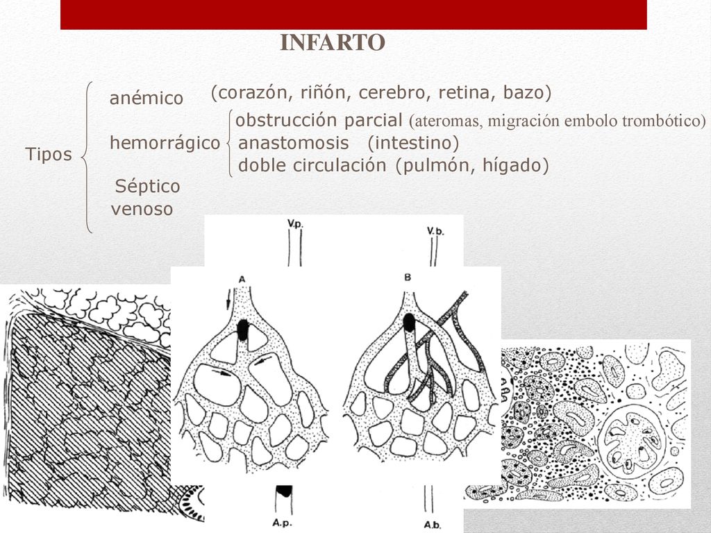 INFARTO (corazón, riñón, cerebro, retina, bazo) anémico