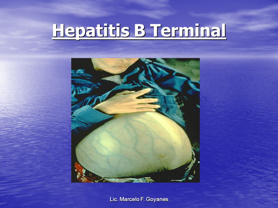 Hepatitis B Terminal Lic. Marcelo F. Goyanes Lic. Marcelo F. Goyanes