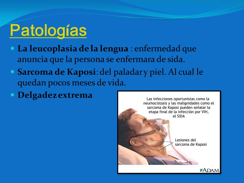 Patologías La leucoplasia de la lengua : enfermedad que anuncia que la persona se enfermara de sida.