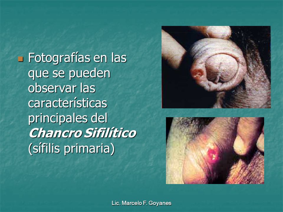 Fotografías en las que se pueden observar las características principales del Chancro Sifilítico (sífilis primaria)