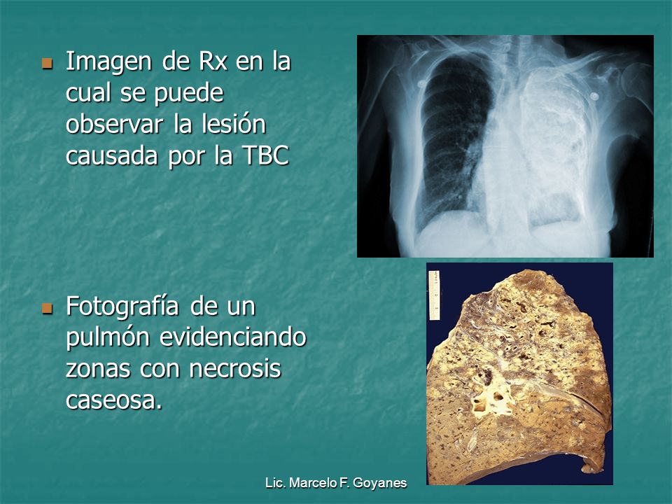 Imagen de Rx en la cual se puede observar la lesión causada por la TBC