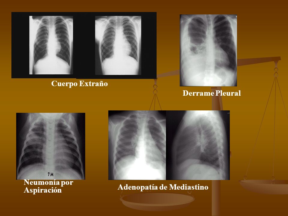 Cuerpo Extraño Derrame Pleural Neumonía por Aspiración Adenopatía de Mediastino