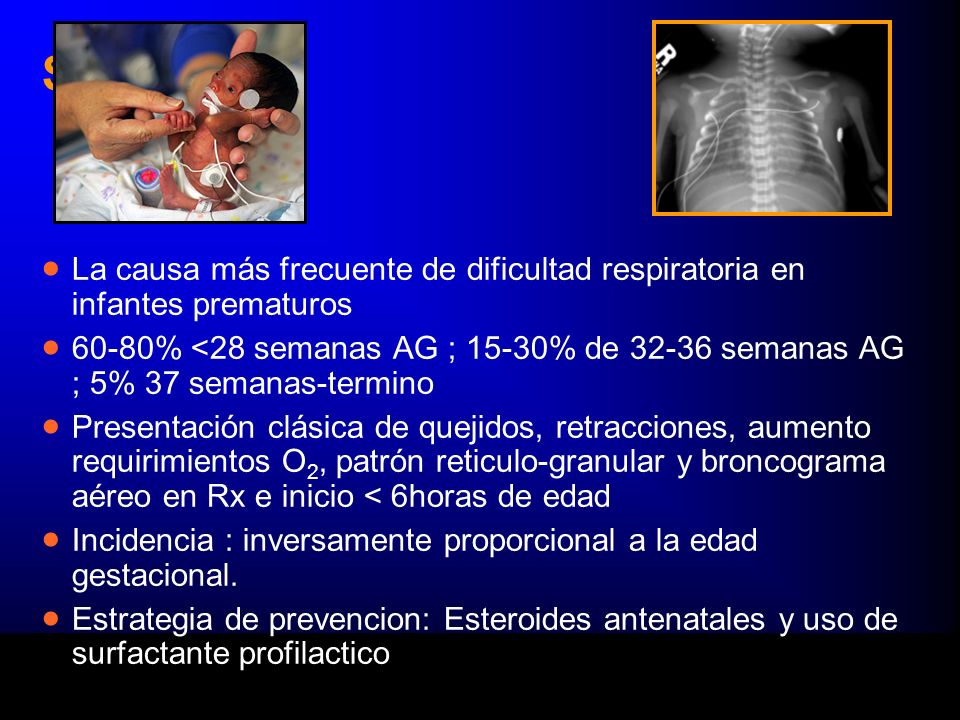 SDR La causa más frecuente de dificultad respiratoria en infantes prematuros.