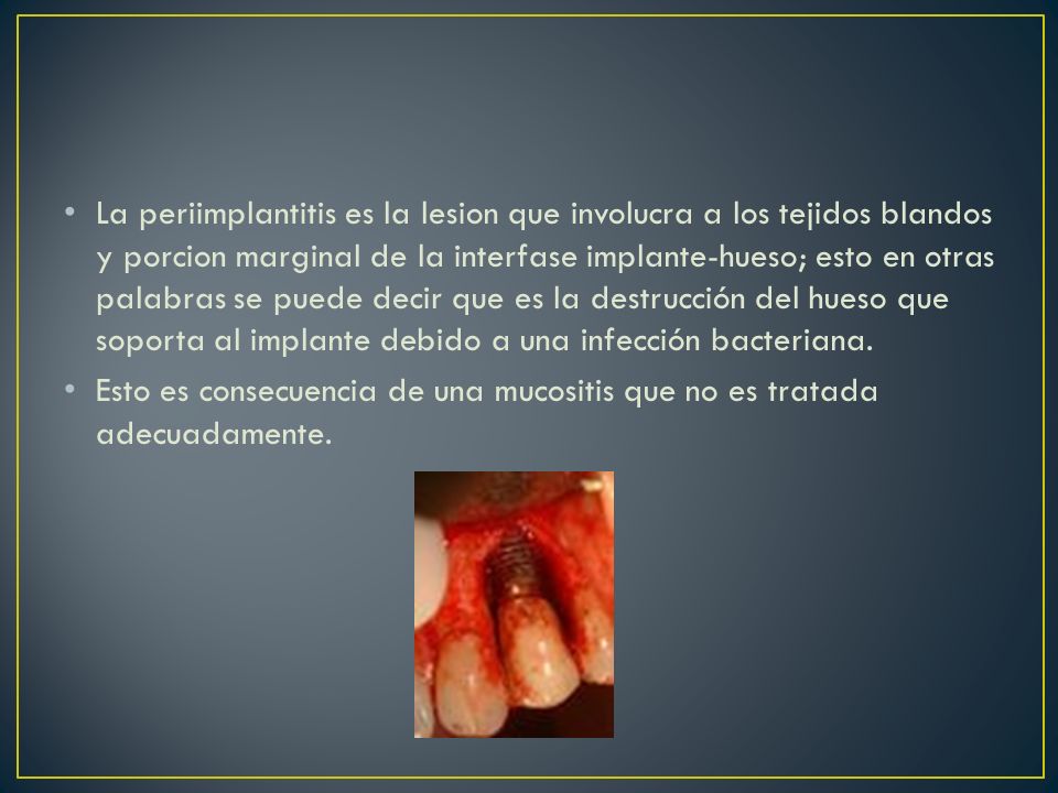 La periimplantitis es la lesion que involucra a los tejidos blandos y porcion marginal de la interfase implante-hueso; esto en otras palabras se puede decir que es la destrucción del hueso que soporta al implante debido a una infección bacteriana.