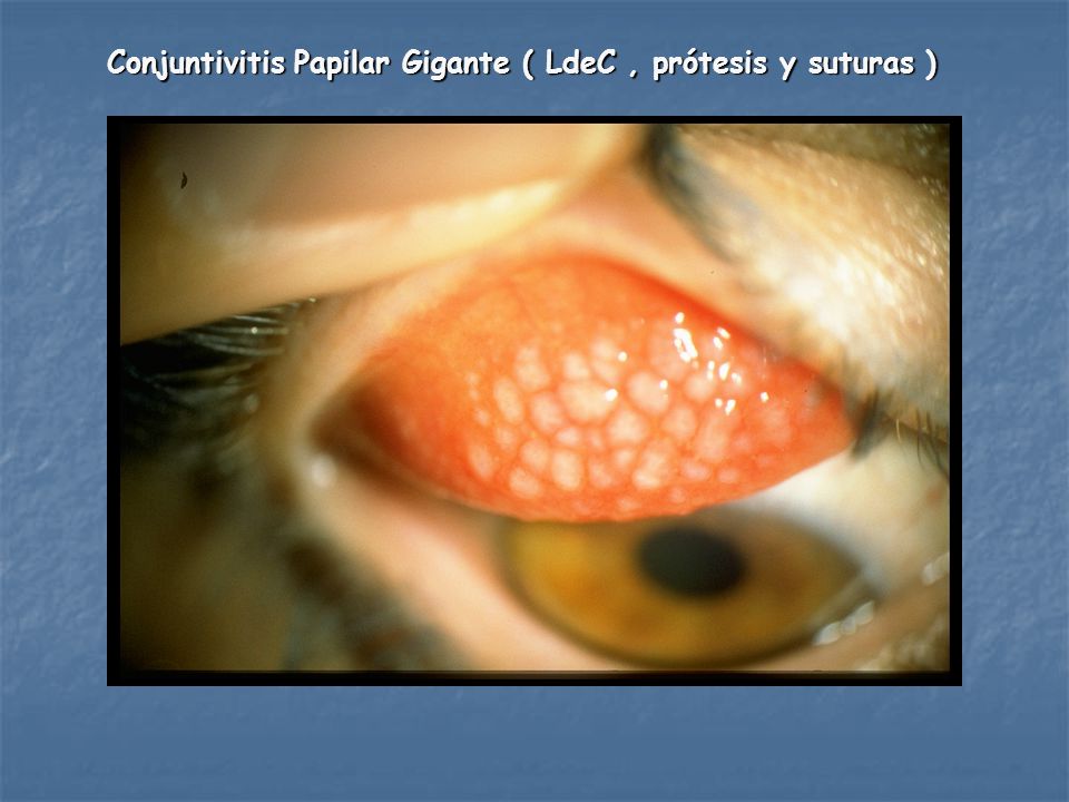 Conjuntivitis Papilar Gigante ( LdeC , prótesis y suturas )