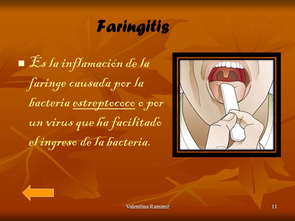 Faringitis Es la inflamación de la faringe causada por la bacteria estreptococo o por un virus que ha facilitado el ingreso de la bacteria.