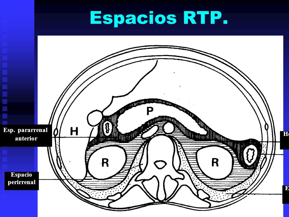 Espacios RTP. Esp. pararrenal anterior Hoja ant. fascia de Gerota