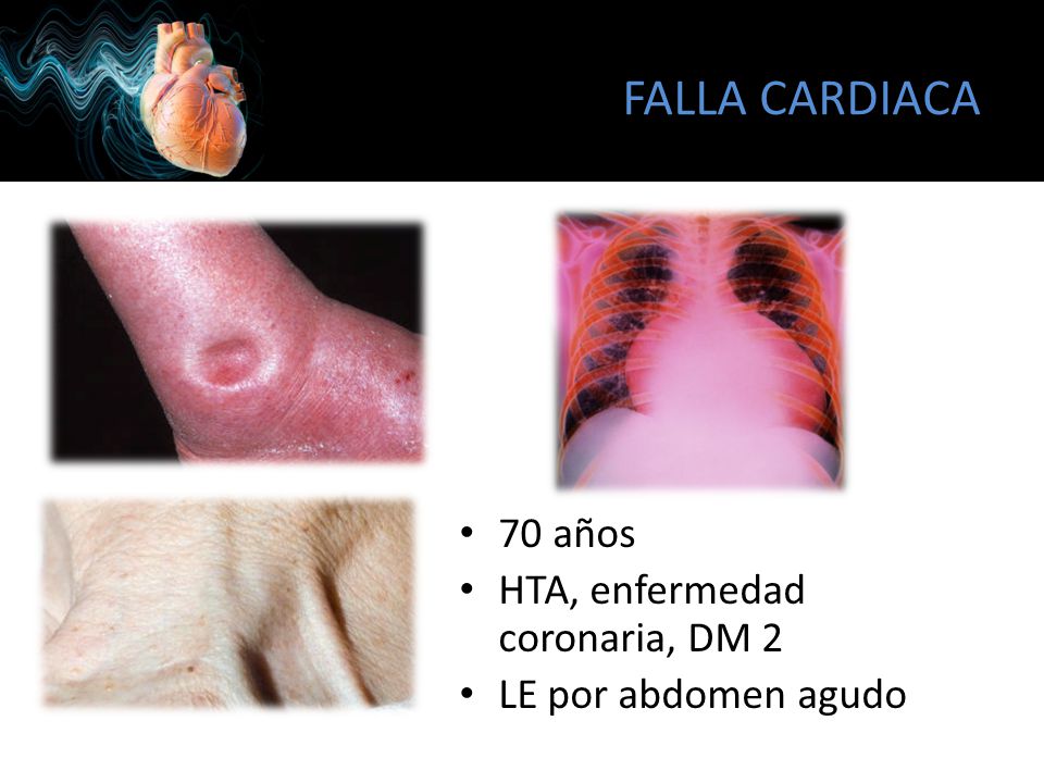 FALLA CARDIACA 70 años HTA, enfermedad coronaria, DM 2