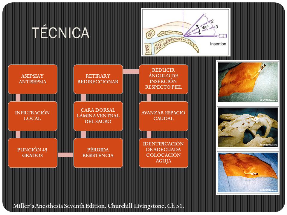 TÉCNICA ASEPSIA Y ANTISEPSIA. INFILTRACIÓN LOCAL. PUNCIÓN 45 GRADOS. PÉRDIDA RESISTENCIA. CARA DORSAL LÁMINA VENTRAL DEL SACRO.