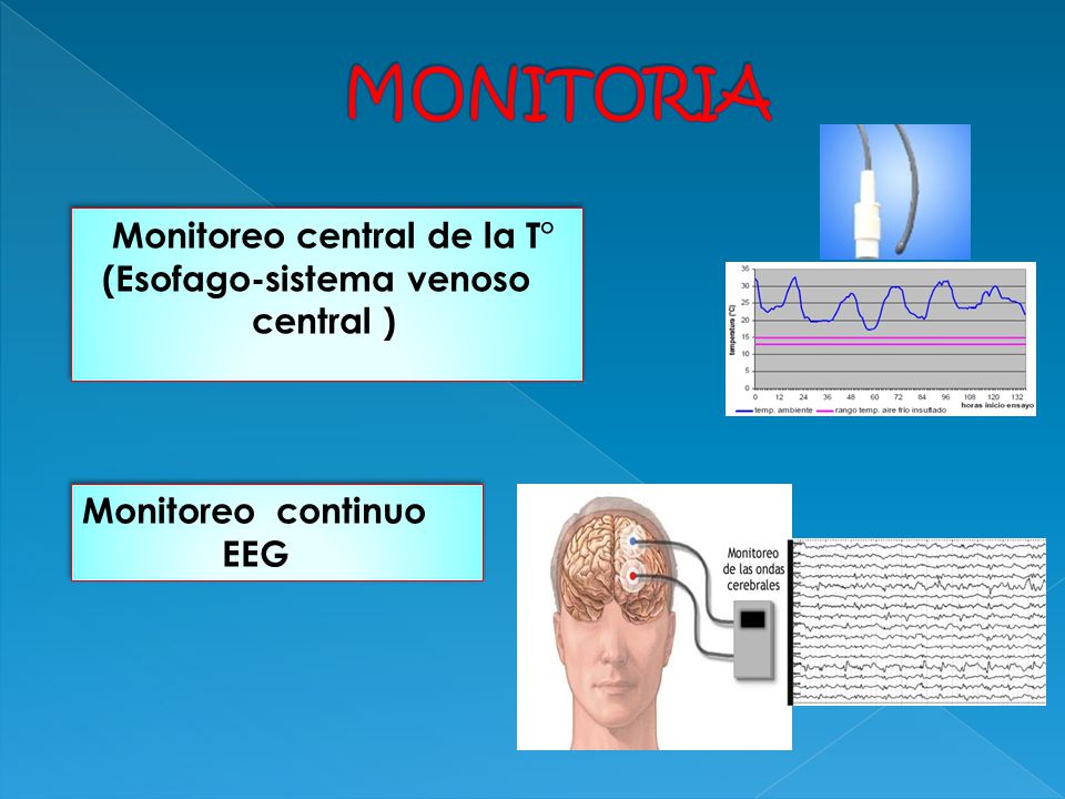 MONITORIA Monitoreo central de la T° (Esofago-sistema venoso central )