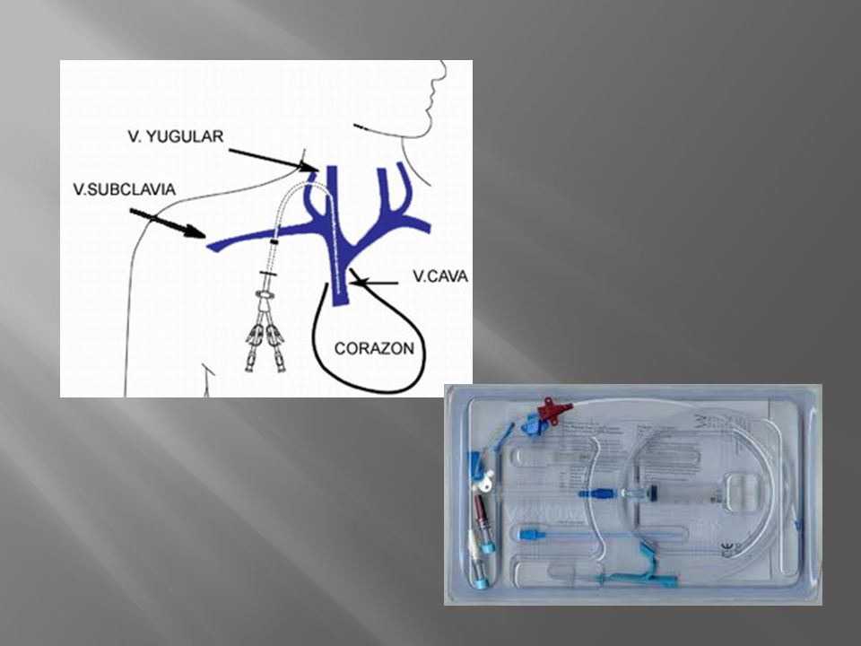 Posicionamiento del transductor: línea esternal izquierda con 4to espacio intercostal, esta mas cerca de auricula der q línea axilar media en esta se puede sobreestimar en 5 mmHg la PVC.
