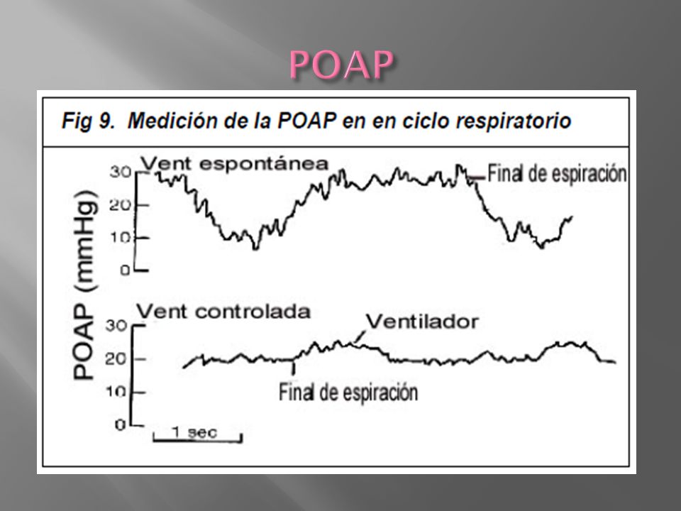 POAP Presión de oclusión de la arteria pulmonar (POAP): Se obtiene inflando el balón para interrumpir el flujo sanguineo a través.