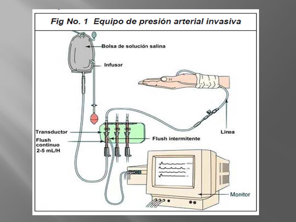 Una cánula colocada percutáneamente en una arteria permite la monitorización de la presión sanguínea y da la posibilidad de obtener muestras de sangre arterial.