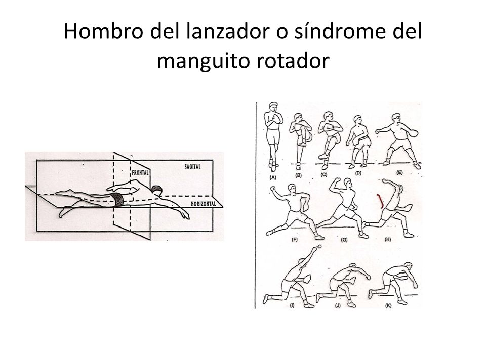 Hombro del lanzador o síndrome del manguito rotador