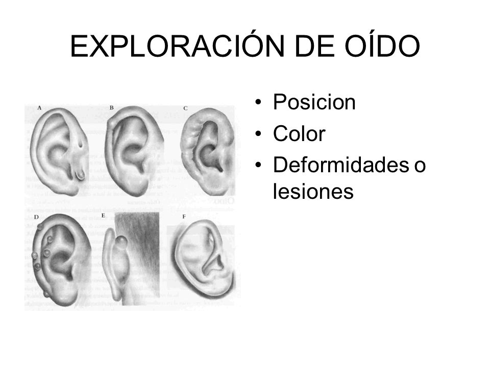 EXPLORACIÓN DE OÍDO Posicion Color Deformidades o lesiones
