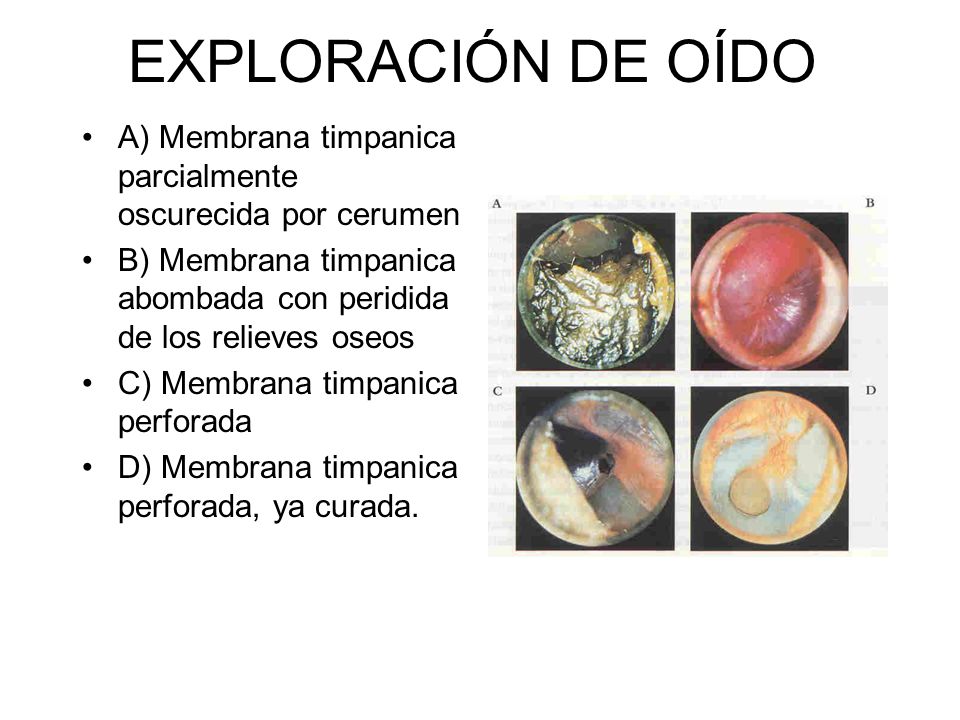 EXPLORACIÓN DE OÍDO A) Membrana timpanica parcialmente oscurecida por cerumen. B) Membrana timpanica abombada con peridida de los relieves oseos.