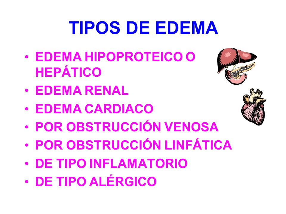 TIPOS DE EDEMA EDEMA HIPOPROTEICO O HEPÁTICO EDEMA RENAL