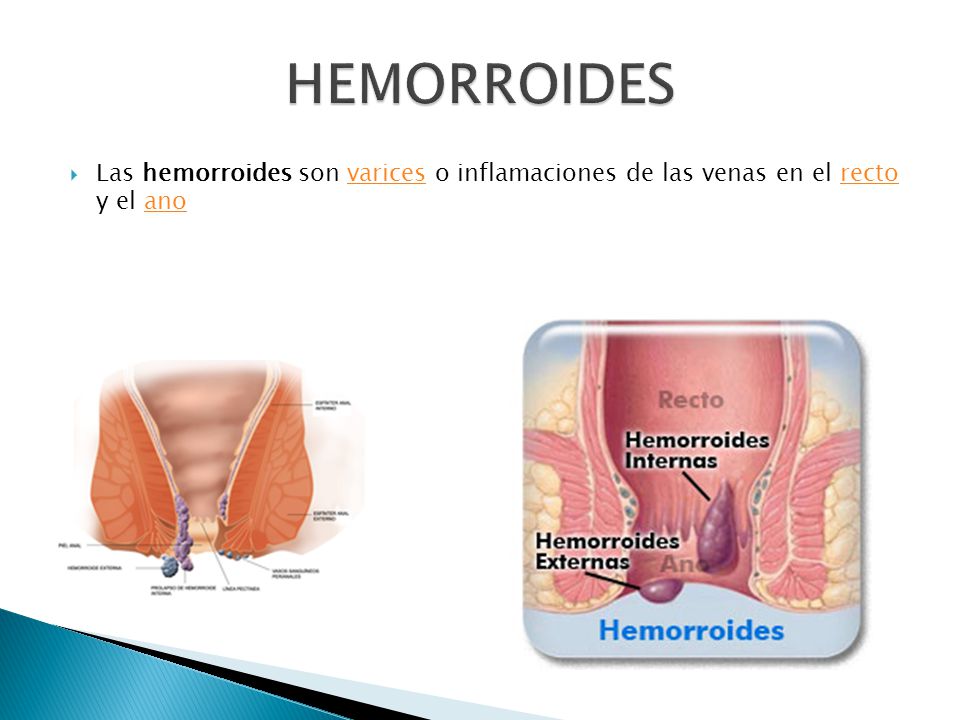 HEMORROIDES Las hemorroides son varices o inflamaciones de las venas en el recto y el ano