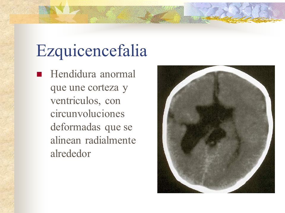 Ezquicencefalia Hendidura anormal que une corteza y ventriculos, con circunvoluciones deformadas que se alinean radialmente alrededor.