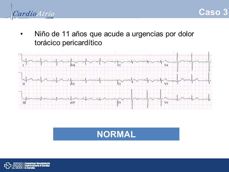 Caso 3 Niño de 11 años que acude a urgencias por dolor torácico pericardítico Normal NORMAL 11