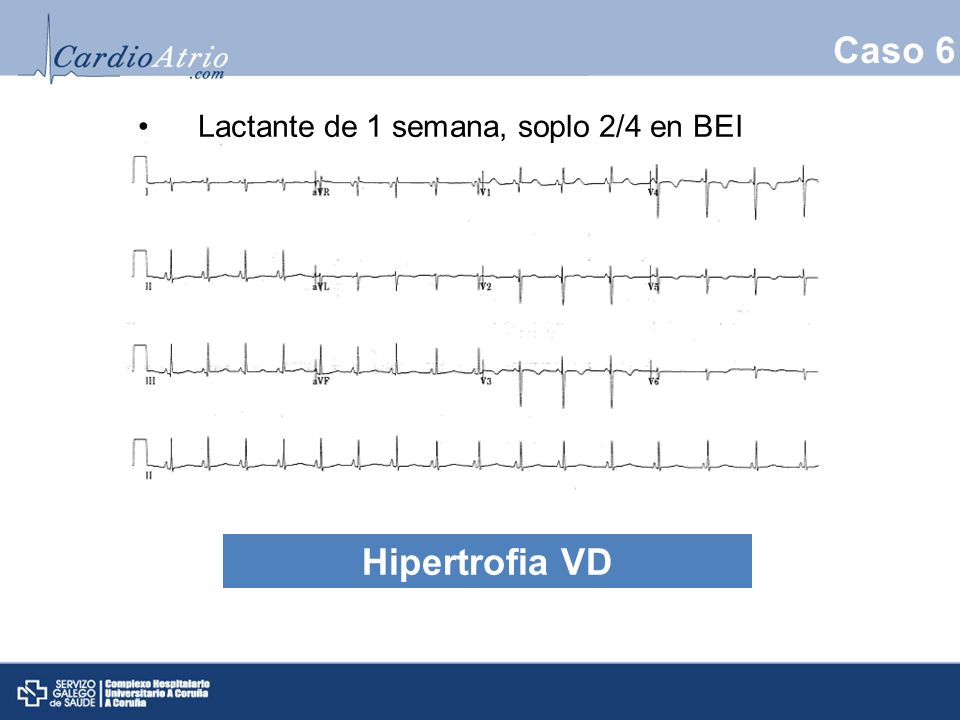 Caso 6 Lactante de 1 semana, soplo 2/4 en BEI HVD Hipertrofia VD 14