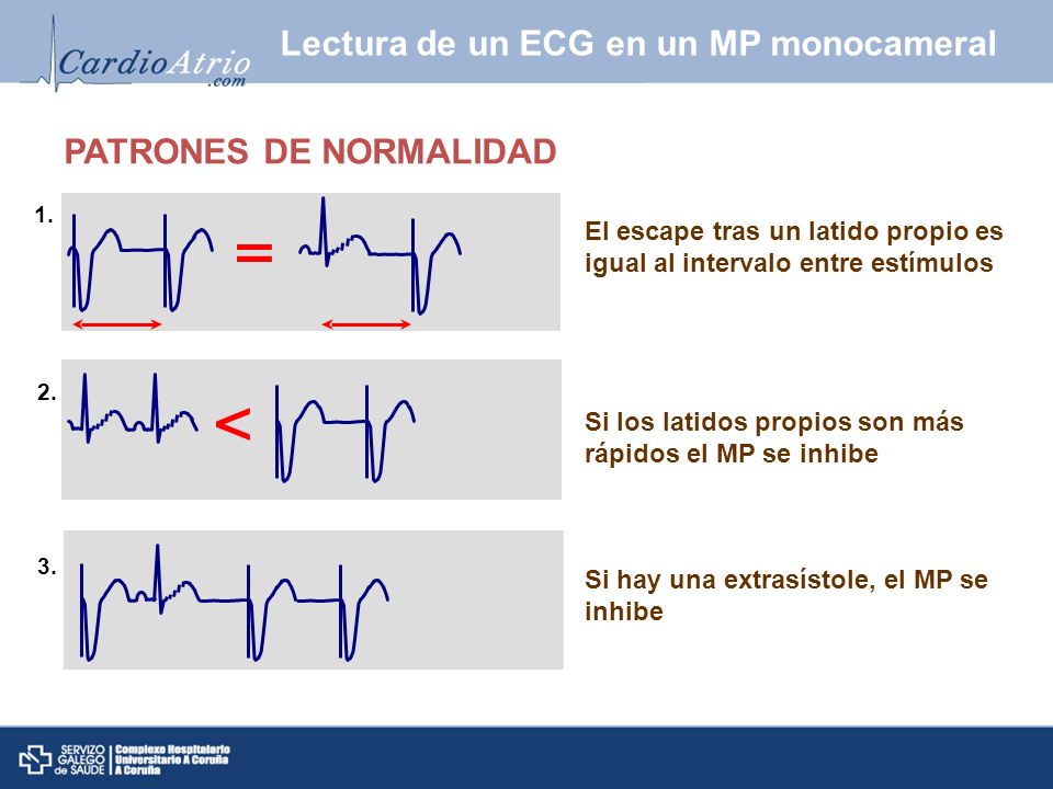 Lectura de un ECG en un MP monocameral