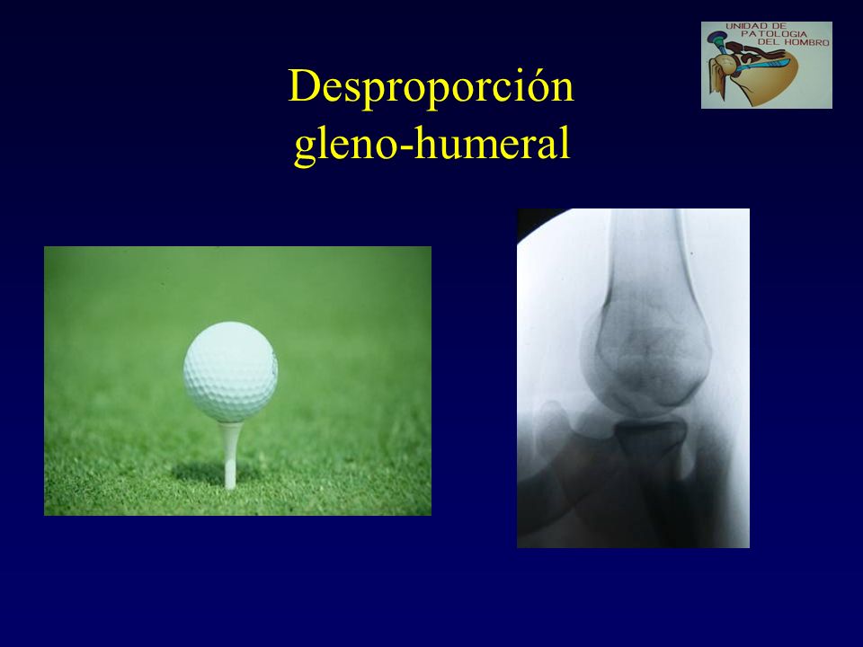 Desproporción gleno-humeral