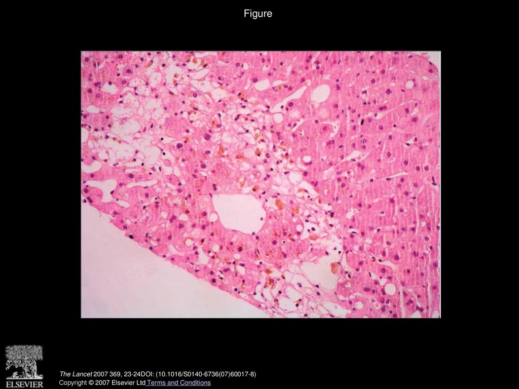 Figure Histological examination showing extensive hepatocellular necrosis in zone 3 of liver acinus.
