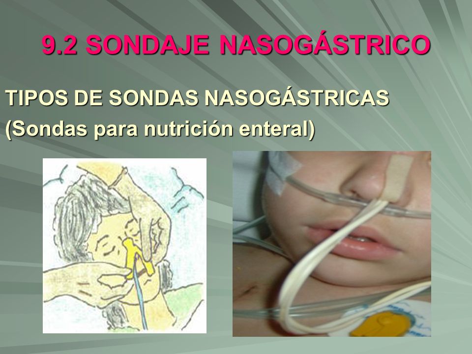 9.2 SONDAJE NASOGÁSTRICO TIPOS DE SONDAS NASOGÁSTRICAS